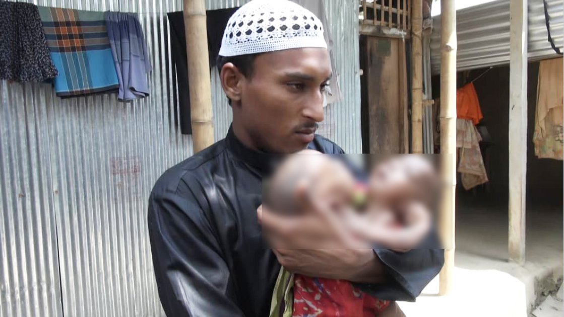 দারিদ্র্যে থমকে আছে জোড়া লাগা যমজ শিশুদের চিকিৎসা