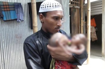 দারিদ্র্যে থমকে আছে জোড়া লাগা যমজ শিশুদের চিকিৎসা