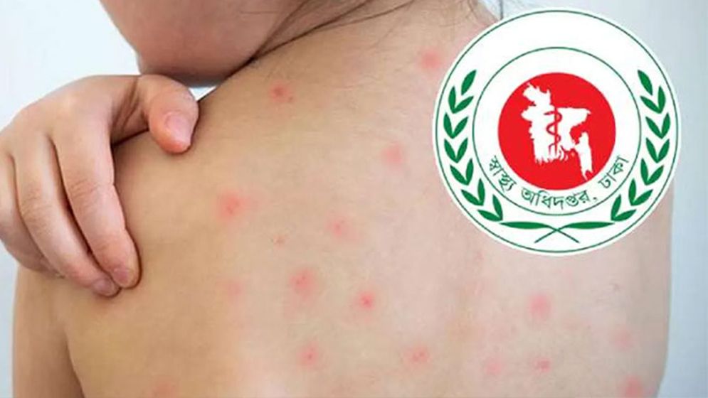 হাম ও হামের উপসর্গ নিয়ে আরও ৪ জনের মৃত্যু