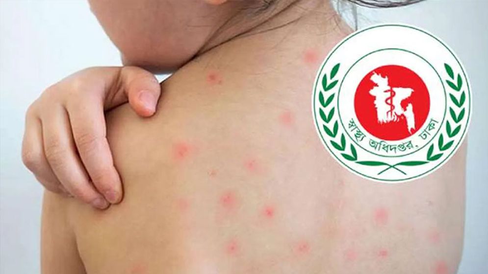হামের উপসর্গে মৃত্যু ৯৮৭, নতুন রোগী ১,১৫৪
