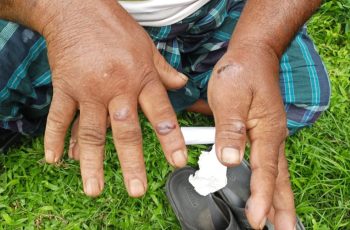 গাইবান্ধায় অ্যানথ্রাক্সের নতুন তিনটি উপসর্গ শনাক্ত